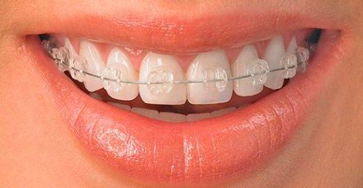 Diş Teli Ağrısı Nasıl Geçer