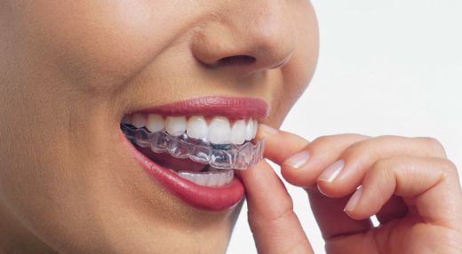 Diş Teli Dişleri Nasıl Düzeltir