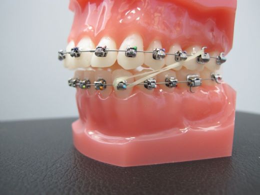 Diş Teli Lastik Çeşitleri