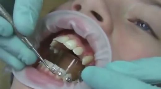 Diş Teli Takımı